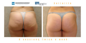 Cellulite Treatment Before & After