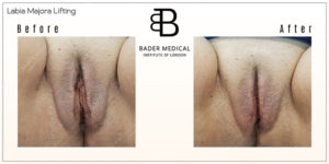 Labia Majora Lifting Surgery Results Greater London