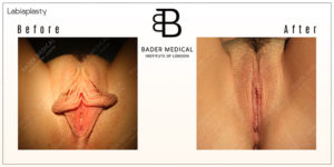 Labiaplasty Results London