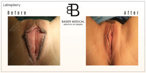 Labiaplasty Results London