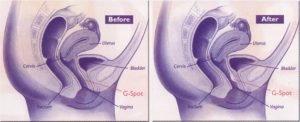 g-spot enhancement