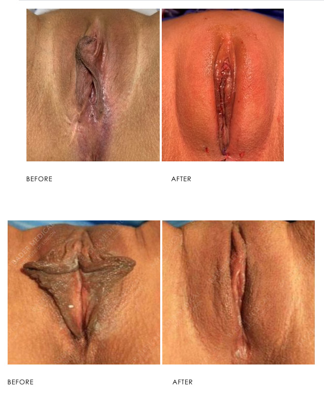 Labia Majora Enhancement with Fat Transfer Before & After