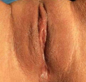 Labia Majora Enhancement with Fat Transfer