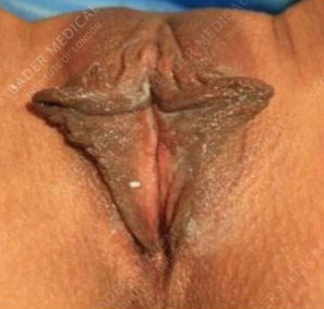 Labia Majora Enhancement with Fat Transfer