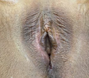 labia majora enhancement via fat transfer
