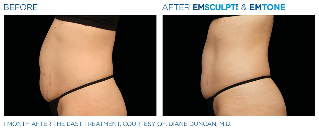 EMSCULPT NEO and EMTONE before and after photo in London