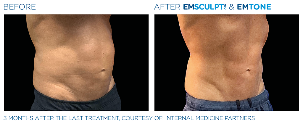 EMSCULPT NEO and EMTONE before and after photo in London