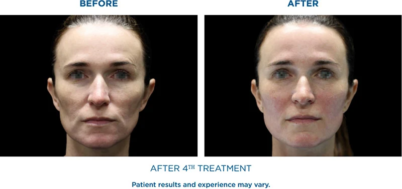 EMFACE after 4th treatment