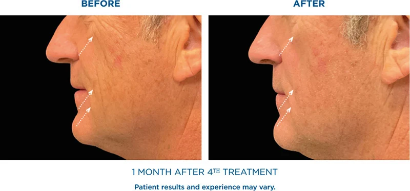 EMFACE after 1 month after 4th treatment