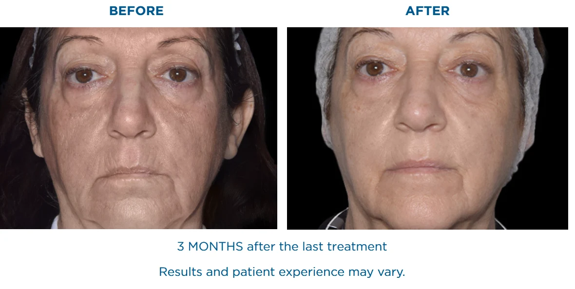 EXION 3 months after the last treatment