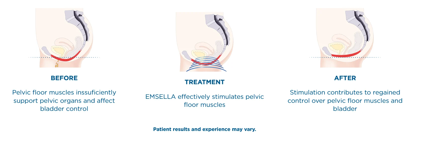 EMSELLA before and after process